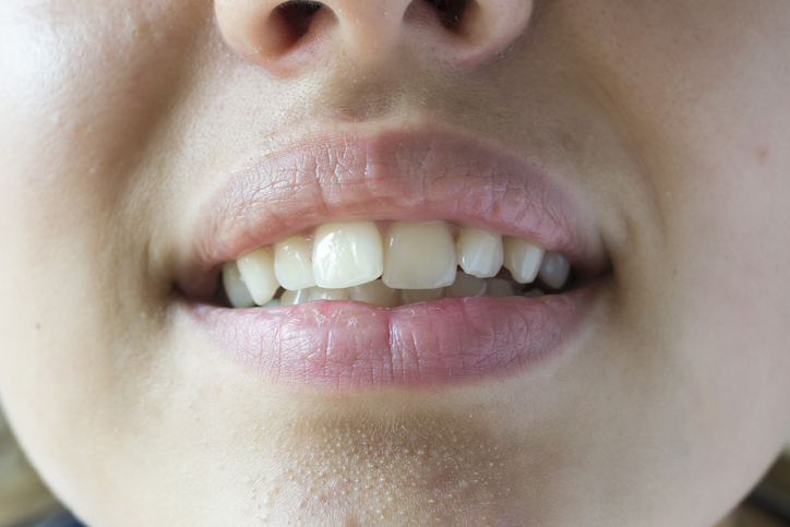 krzywe zęby u kobiety