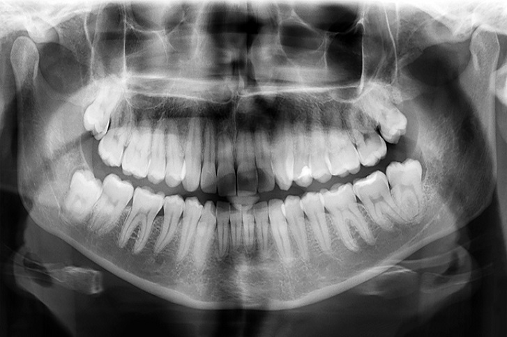 zdjęcie pantomograficzne zębów 