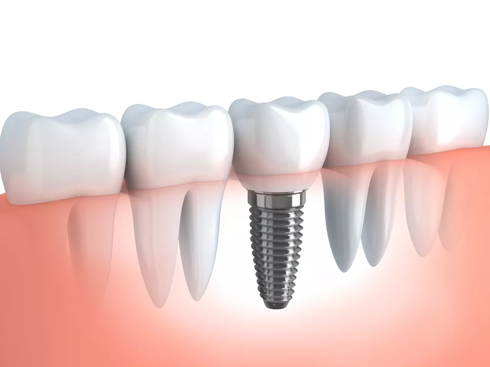 Grafika przedstawiająca implant zęba