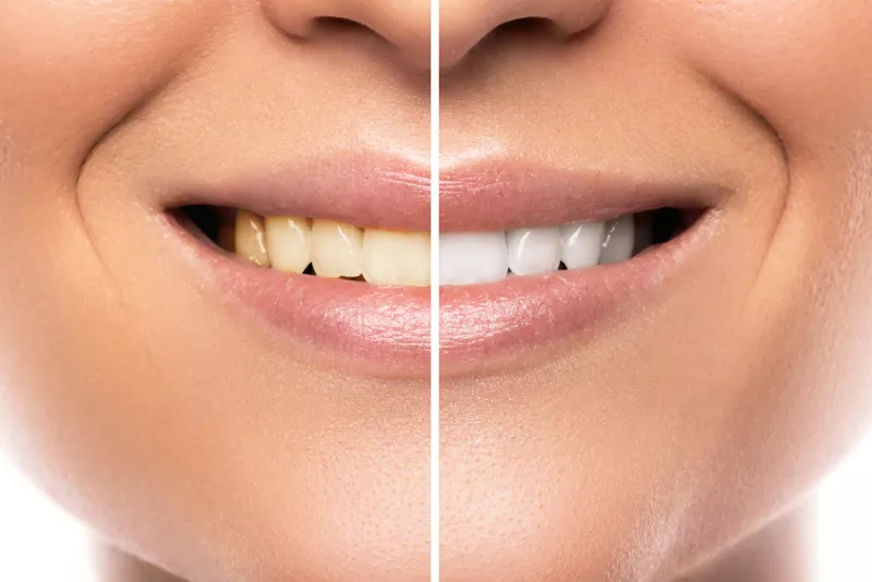 Wybielanie zębów, przed i po