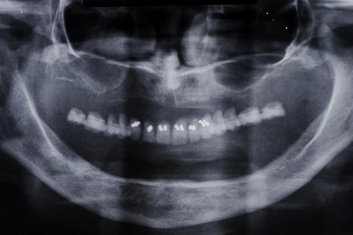 Zdjęcie rentgenowskie zatok