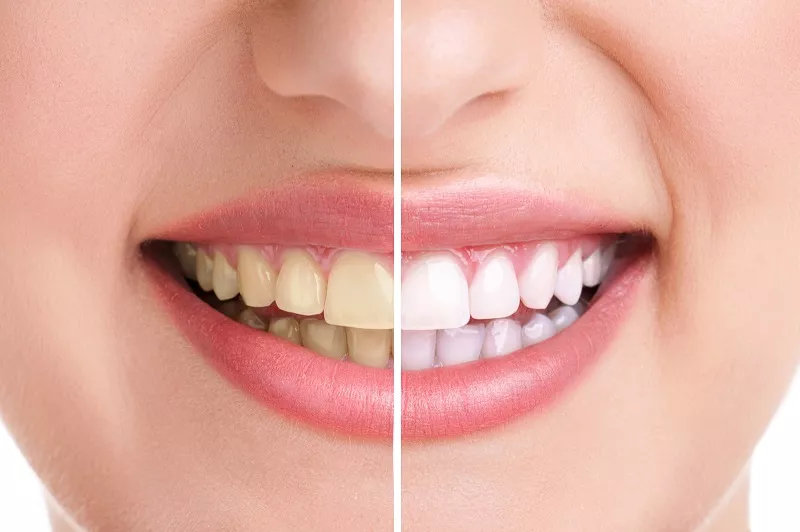 Porównanie kolorów zębów